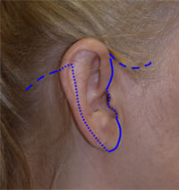 face lift incision